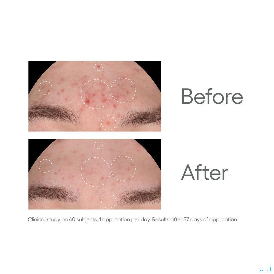 Aderma Biology Ac Night Peel Serum A/Imperf. 30 ml
